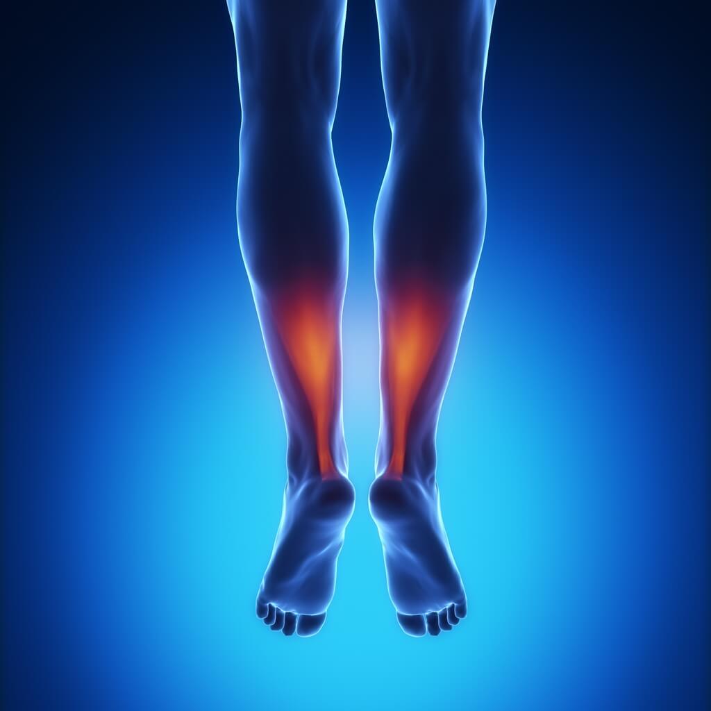 Zapalenie ścięgna Achillesa (tendinitis) – objawy, konsekwencje zaniedbania, leczenie
