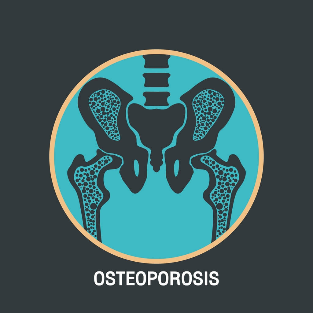 Osteporoza - przyczyny, leczenie. Dieta przy osteoporozie